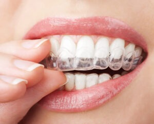 ارتودنسی نامرئی؛ مزایا، معایب و هرآنچه باید بدانید