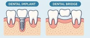 bridge vs implant