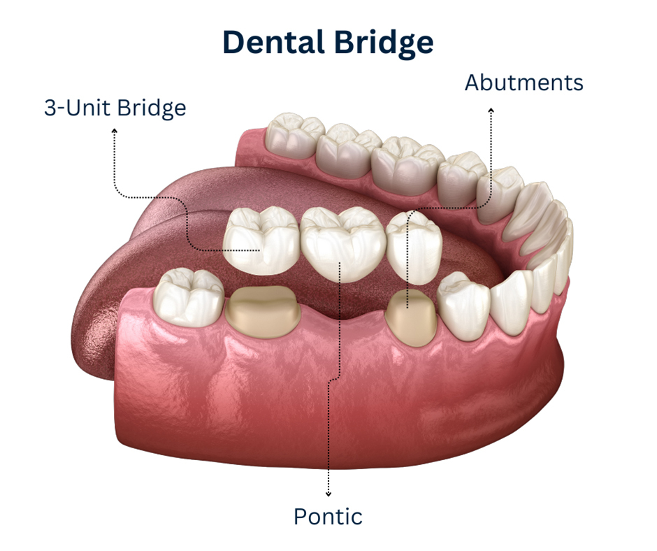 dental-bridge