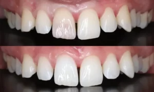 Endo-Bleaching