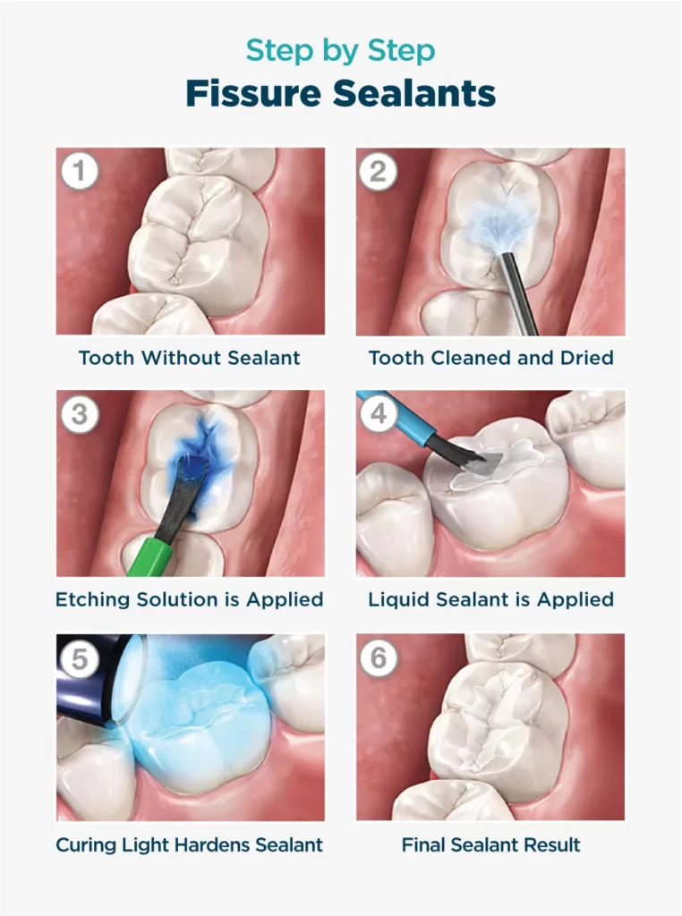 fissure sealants